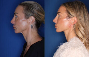 photo before and after - 45 year old female 5 months post KalosLift extended deep plane facelift with platysmaplasty neck lift