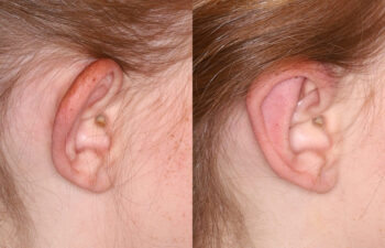 Side-by-side images of a person's ear, showing a small bump on the earlobe in the left image and a smooth earlobe without the bump in the right image.