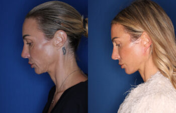 photo before and after - 45 year old female 5 months post KalosLift extended deep plane facelift with platysmaplasty neck lift