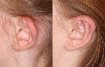 Side-by-side comparison of a person's ear before and after a medical or cosmetic procedure, showing a change in ear shape and appearance.