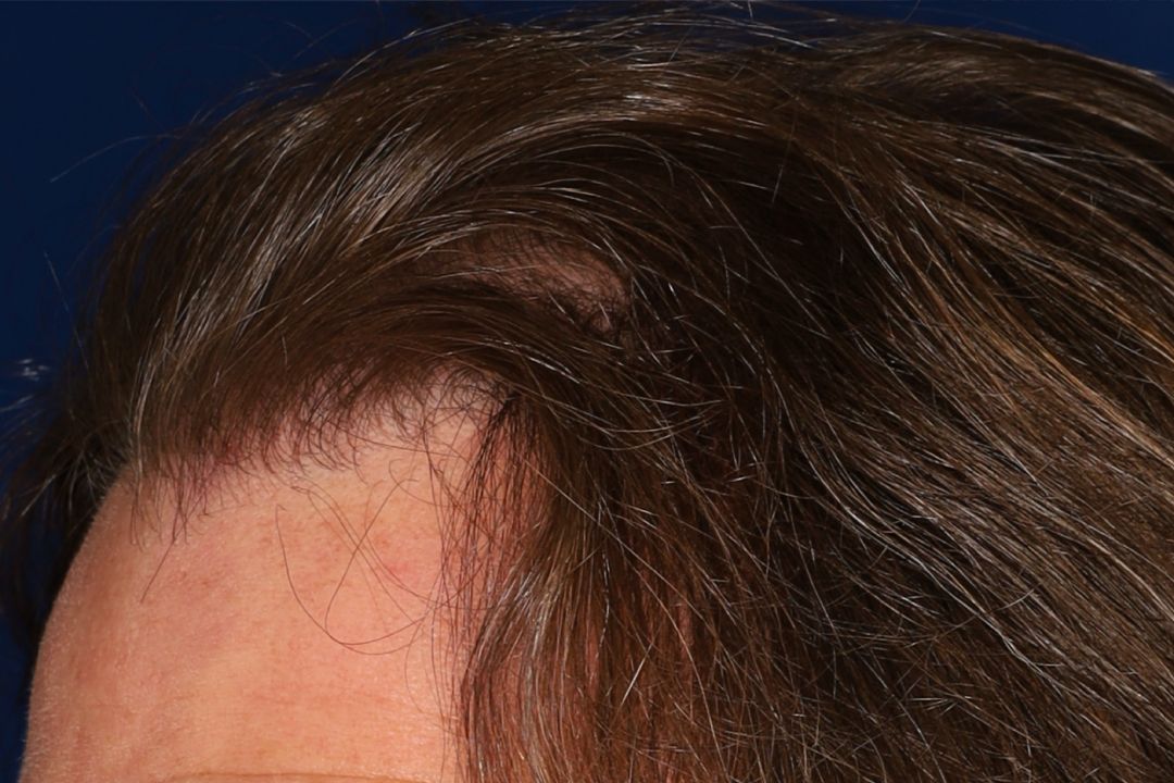 Close-up of a person's hairline and part of their forehead, showing brown hair combed to the side against a dark blue background.