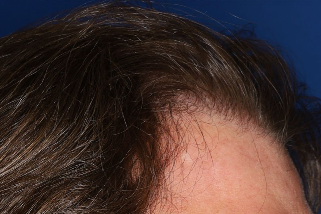 Close-up of a person's forehead and hairline with brown hair against a blue background.