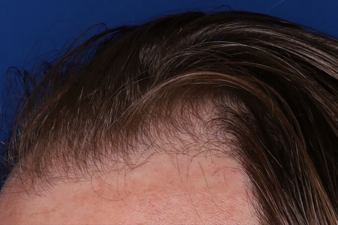 Close-up of a person's hairline and forehead against a blue background, showing thinning hair at the front.