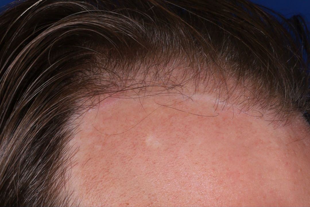 Close-up of a person's forehead and hairline, showing thinning hair and some individual hairs standing out near the scalp.