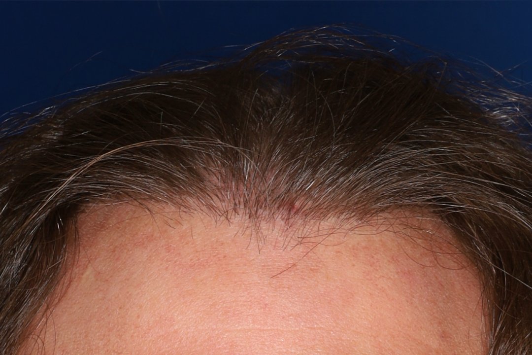 Close-up of a person's hairline and forehead with thin, dark brown hair against a dark blue background.