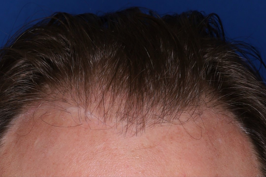 A close-up view of a person's hairline and forehead against a blue background.