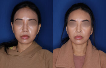 Side-by-side photos of a woman with blurred eyes, before and after a treatment or procedure, both against a blue background and wearing tan clothing.