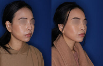Side-by-side photos of a woman before and after a cosmetic procedure, showing changes in facial contours and skin texture against a blue background.
