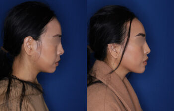 Side-by-side profile photos of a woman before and after a cosmetic procedure, showing changes to the jawline and chin against a blue background.