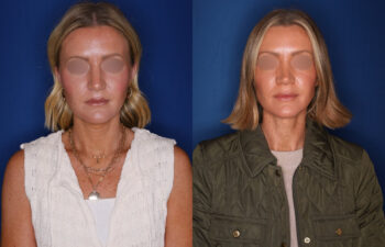 photo before and after - 39 year old female 1.5 years post revision rhinoplasty