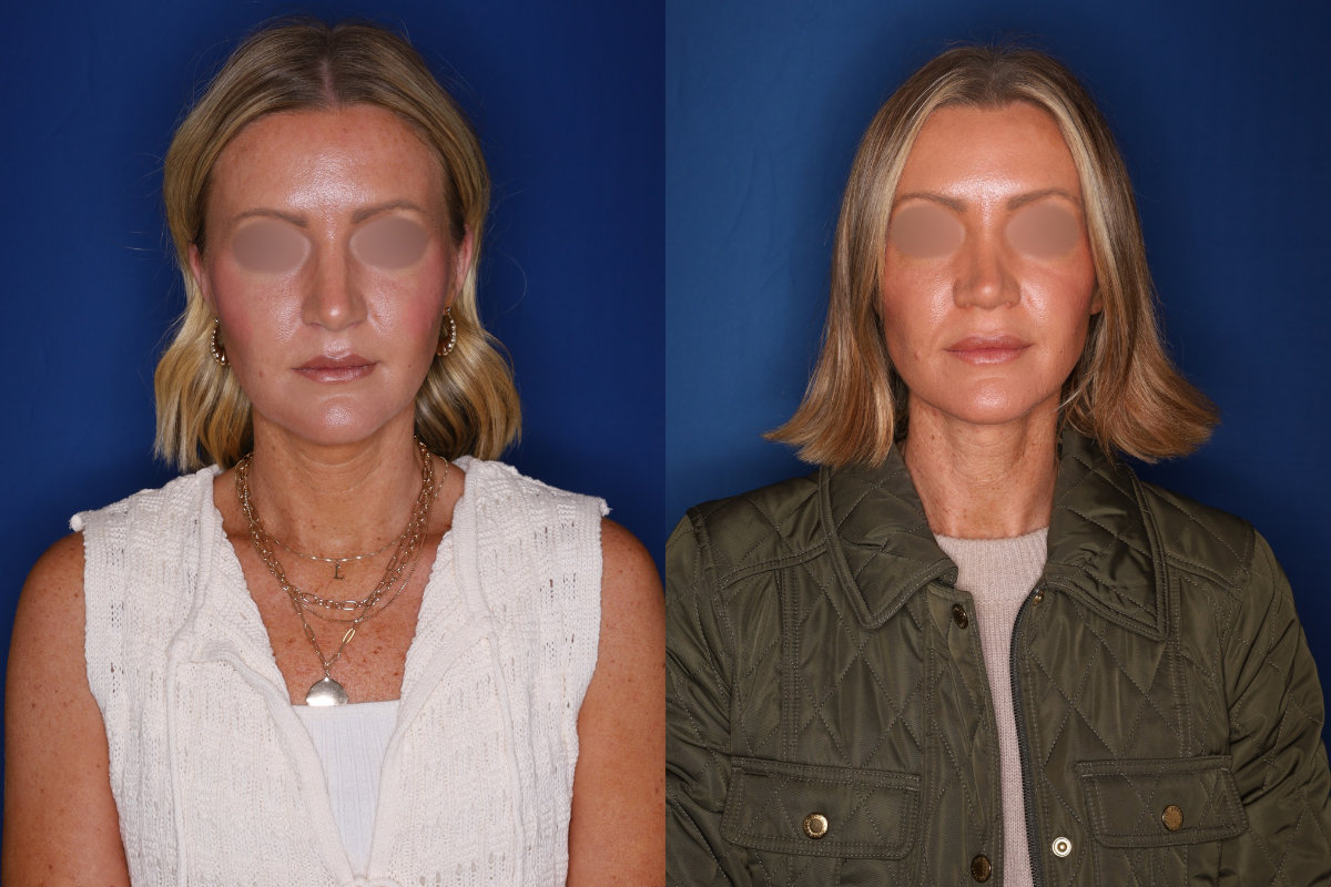 photo before and after - 39 year old female 1.5 years post revision rhinoplasty