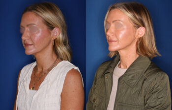 photo before and after - 39 year old female 1.5 years post revision rhinoplasty