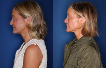 photo before and after - 39 year old female 1.5 years post revision rhinoplasty