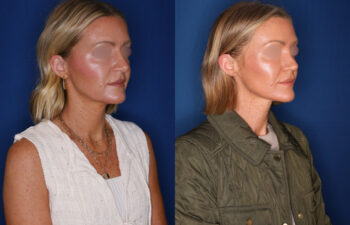 photo before and after - 39 year old female 1.5 years post revision rhinoplasty