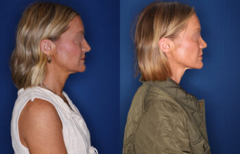 photo before and after - 39 year old female 1.5 years post revision rhinoplasty