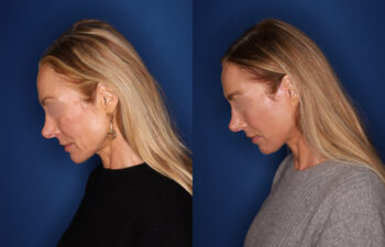 woman before and after Facelift, Kaloslift, Necklift