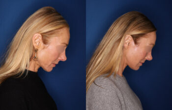 woman before and after Facelift, Kaloslift, Necklift