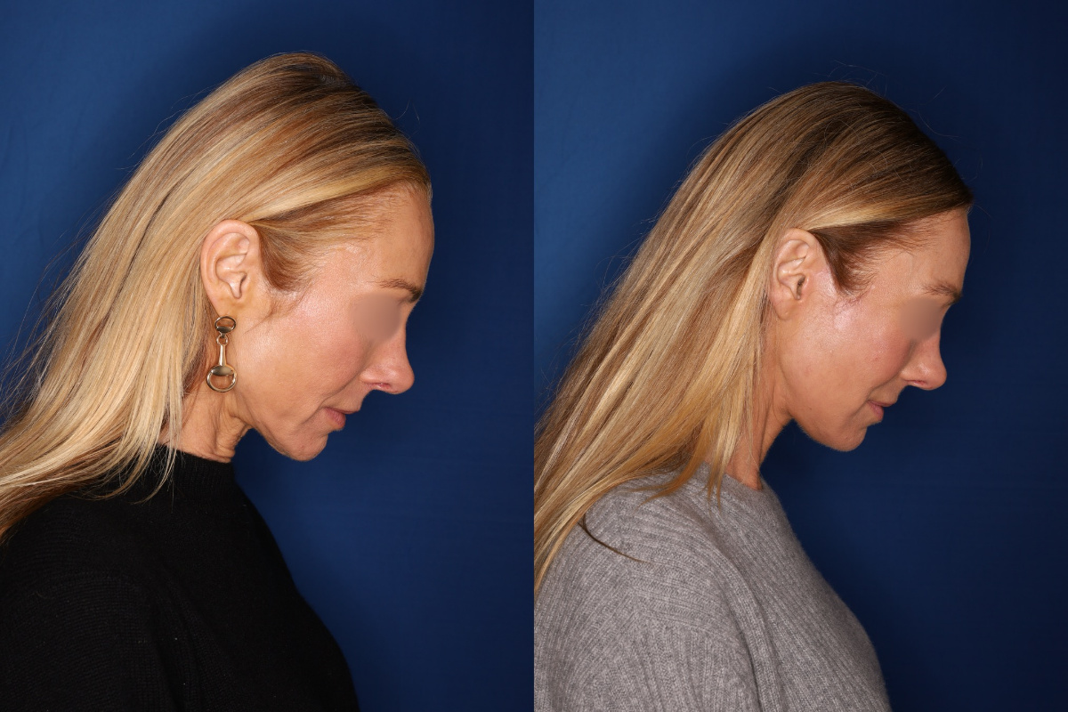woman before and after Facelift, Kaloslift, Necklift