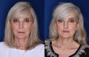 Side-by-side photos of an older woman with gray hair, showing her face before (left) and after (right) a visible cosmetic or medical procedure, both set against a blue background.