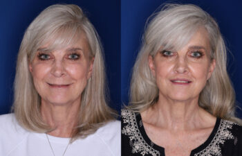 59 year old female 3 months post perialar lip lift