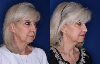 59 year old female 3 months post perialar lip lift