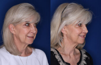 59 year old female 3 months post perialar lip lift