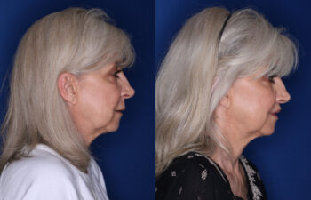 59 year old female 3 months post perialar lip lift