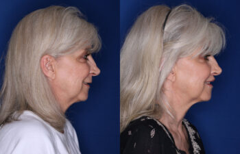 59 year old female 3 months post perialar lip lift