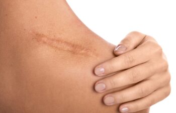 Close up of female shoulder with a scar