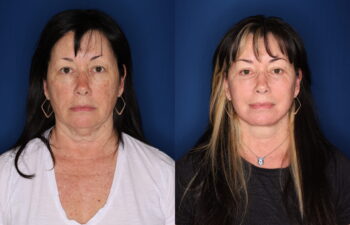 63 year old female 3 months post lower blepharoplasty with fat transposition and CO2RE fractional ablative laser resurfacing to the cheeks only, and 1 year post upper blepharoplasty and KalosLift extended deep plane facelift with platysmaplasty neck lift