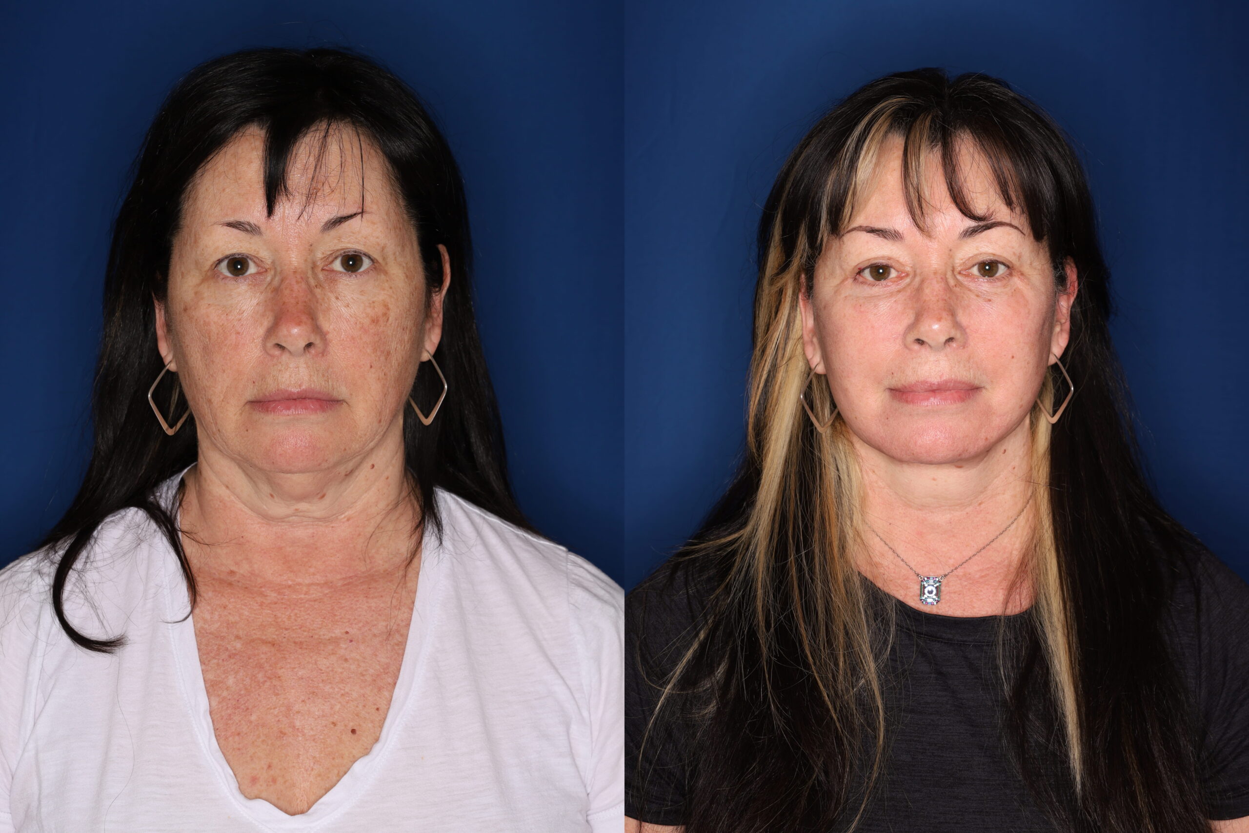 63 year old female 3 months post lower blepharoplasty with fat transposition and CO2RE fractional ablative laser resurfacing to the cheeks only, and 1 year post upper blepharoplasty and KalosLift extended deep plane facelift with platysmaplasty neck lift