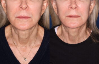 69 year old female 3.5 months post revision KalosLift mini extended deep plane facelift with platysmaplasty neck lift