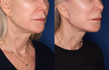 69 year old female 3.5 months post revision KalosLift mini extended deep plane facelift with platysmaplasty neck lift