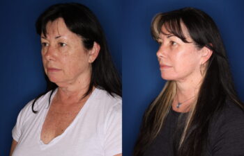 63 year old female 3 months post lower blepharoplasty with fat transposition and CO2RE fractional ablative laser resurfacing to the cheeks only, and 1 year post upper blepharoplasty and KalosLift extended deep plane facelift with platysmaplasty neck lift