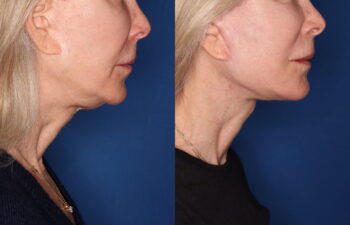 69 year old female 3.5 months post revision KalosLift mini extended deep plane facelift with platysmaplasty neck lift