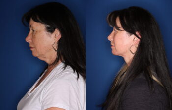 63 year old female 3 months post lower blepharoplasty with fat transposition and CO2RE fractional ablative laser resurfacing to the cheeks only, and 1 year post upper blepharoplasty and KalosLift extended deep plane facelift with platysmaplasty neck lift