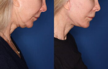 69 year old female 3.5 months post revision KalosLift mini extended deep plane facelift with platysmaplasty neck lift