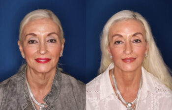 Two side-by-side portraits of an older woman with long blonde hair, wearing earrings and necklaces, posing against a blue background before and after an apparent cosmetic procedure.