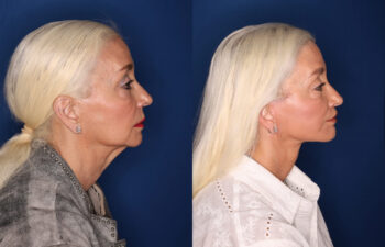Side-by-side profiles of an older woman before (left) and after (right) a cosmetic procedure, showing reduced sagging and a more defined jawline against a blue background.