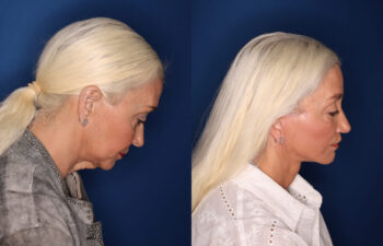 Side-by-side profile images of an older woman before and after a cosmetic procedure, showing smoother neck and jawline in the after photo.