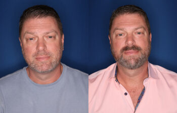 before and after 58 year old male 5 months post fat transposition lower blepharoplasty