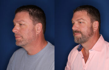 before and after 58 year old male 5 months post fat transposition lower blepharoplasty