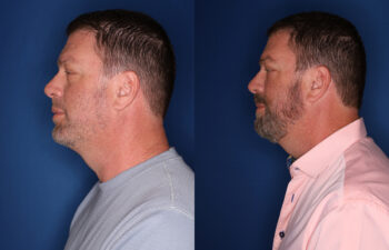 before and after 58 year old male 5 months post fat transposition lower blepharoplasty