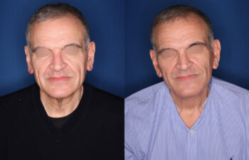before and after photo - 59 year old male 5 months post KalosLift mini extended deep plane facelift with platysmaplasty neck lift