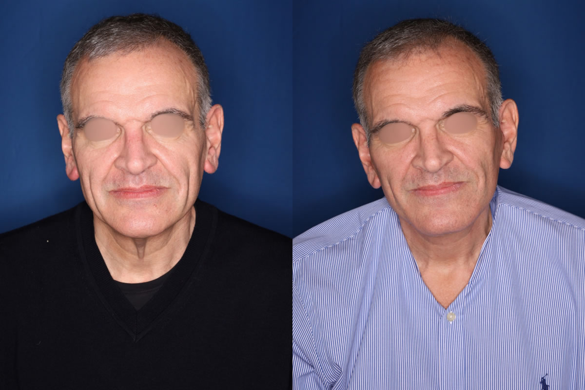 before and after photo - 59 year old male 5 months post KalosLift mini extended deep plane facelift with platysmaplasty neck lift
