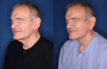 before and after photo - 59 year old male 5 months post KalosLift mini extended deep plane facelift with platysmaplasty neck lift