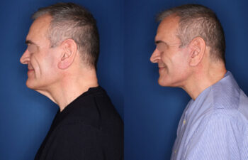 before and after photo - 59 year old male 5 months post KalosLift mini extended deep plane facelift with platysmaplasty neck lift