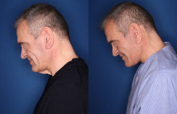 before and after photo - 59 year old male 5 months post KalosLift mini extended deep plane facelift with platysmaplasty neck lift