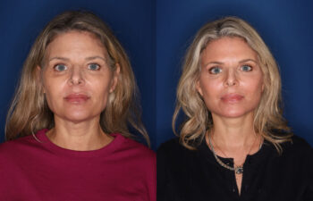 Side-by-side images of the same woman before and after a cosmetic procedure, showing changes in skin tone, facial contours, and hair style.