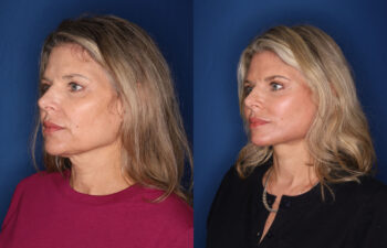 Side-by-side photos show a woman before and after a cosmetic procedure, highlighting changes in facial contours and skin tone.